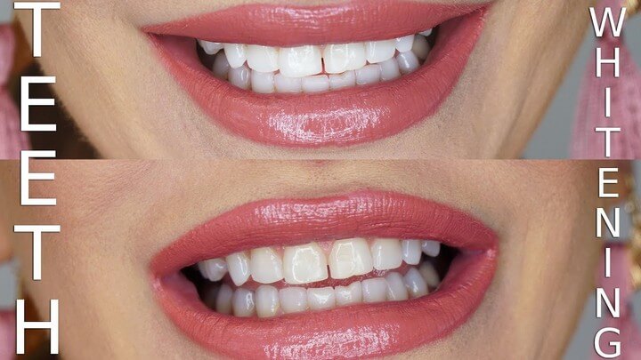 Homemade teeth whitening methods